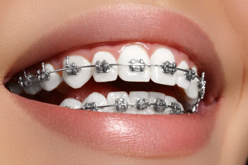 Affordable Dental Braces In The Philippines And MORE – Asian Sun Dental ...