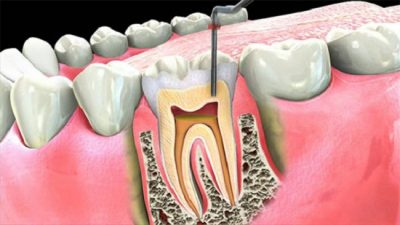 featured image for root canal from a Manila dental clinic