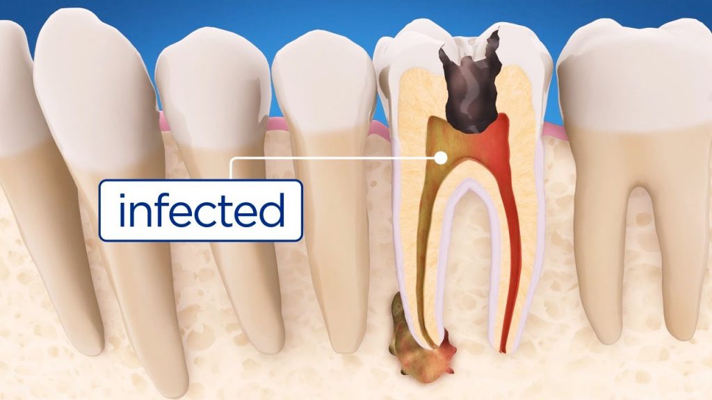 image for root canal from a Manila dental clinic