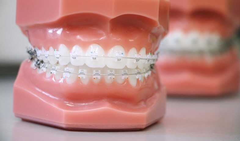 Пластиковые брекеты Томск Чулымская стоматология томск улыбка на смирнова