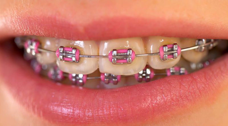 featured image for affordable dental braces in the Philippines