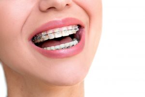 image for damon braces