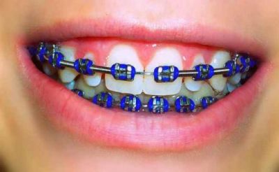 featured image for dental braces in manila