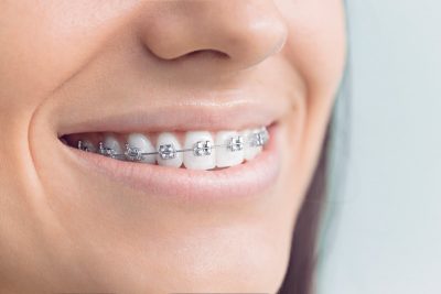 featured image for price of braces in the philippines