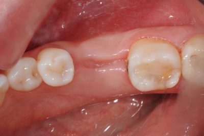 featured image for healing time for tooth extraction