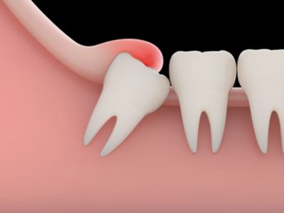 featured image for impacted wisdom tooth removal