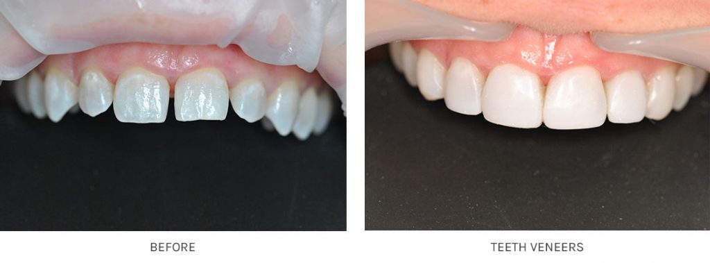 Photos shaved teeth for porceline veneers