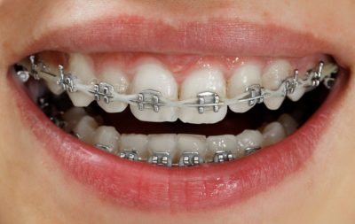 image for price of ceramic braces in the philippines