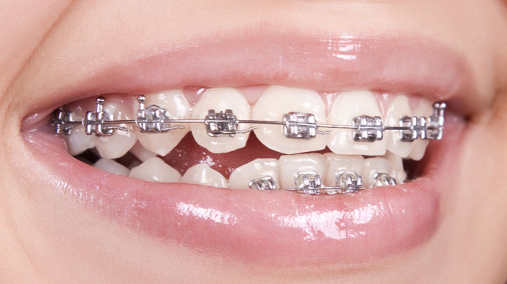 image for ceramic braces vs. metal braces