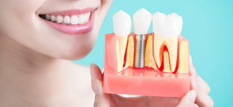 featured image for tooth implant in the philippines