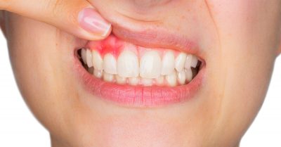 featured image for how to treat gum disease