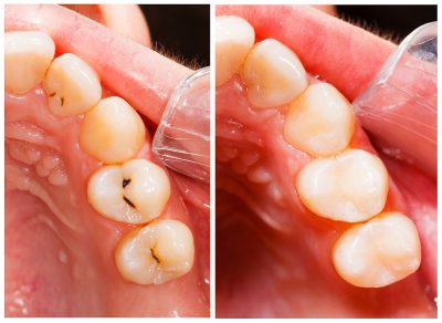 featured image for composite resin restoration procedure