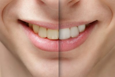 featured image for laser teeth whitening procedure