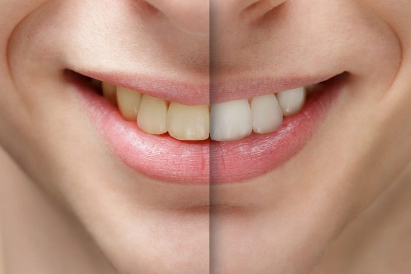 featured image for laser teeth whitening procedure
