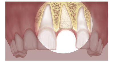 featured image for benefits of bone grafting