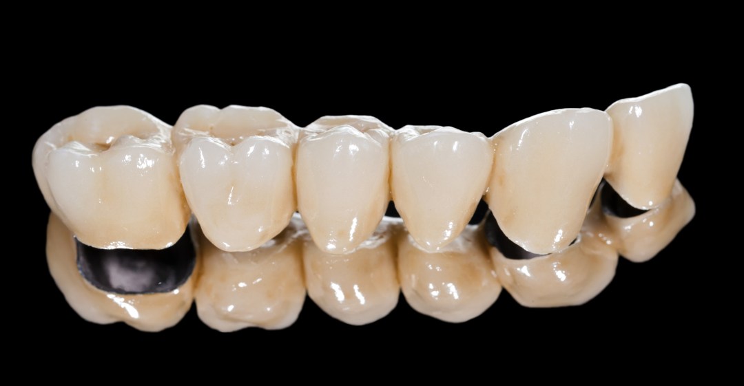 image for porcelain bridges vs. dentures