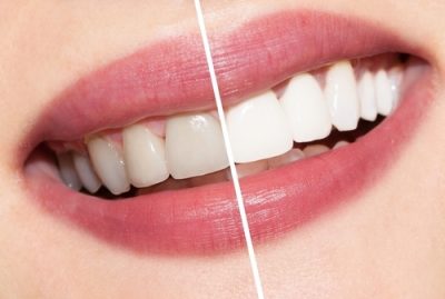 featured image for do i need teeth whitening