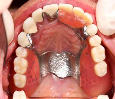 featured image for Cost of Partial Dentures in the Philippines