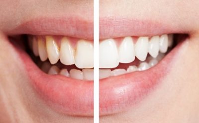 featured image for laser in teeth whitening