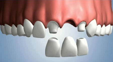  fixed dental bridge cost uk