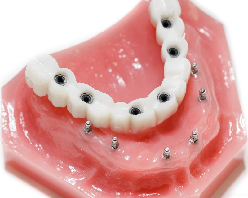 featured image for permanent dentures in the Philippines