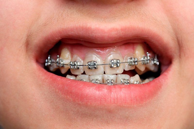featured image for price of braces in manila