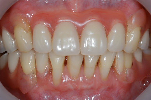 image for flexible dentures