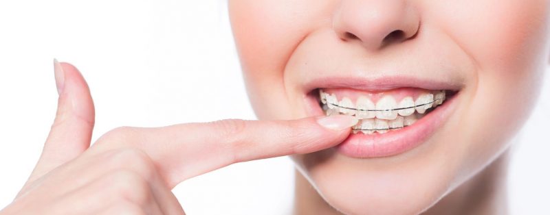 How Much Does It Cost To Get Braces in Manila