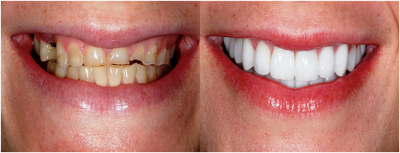 featured image for cost of emax veneers in the philippines