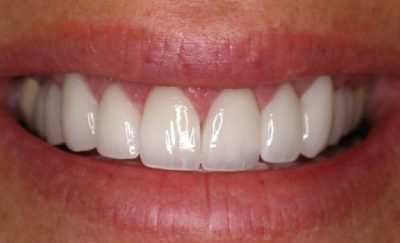 featured image for veneers