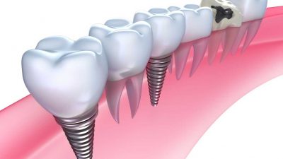 featured image for how much are dental implants in the philippines