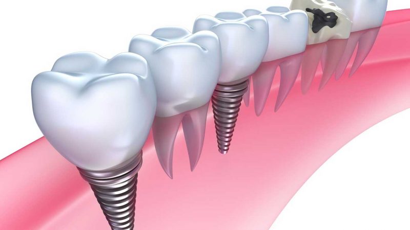featured image for how much are dental implants in the philippines