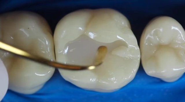 image for cost of teeth restoration in the philippines