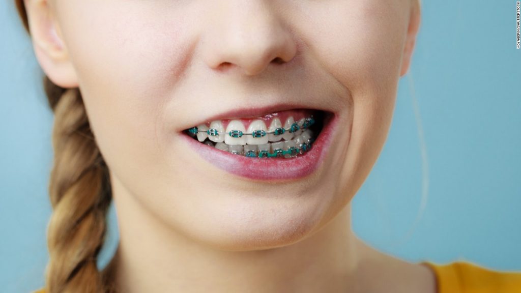 How Much Does It Cost To Get Braces in Manila
