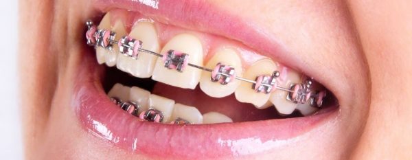 How Much are Braces in Manila? – Asian Sun Dental Clinic Manila