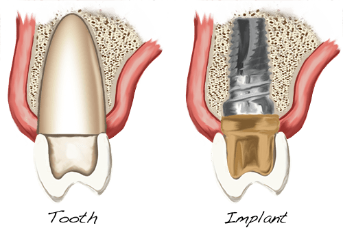 image for price of a tooth implant in the philippines