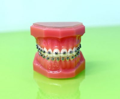 featured image for Should you get braces