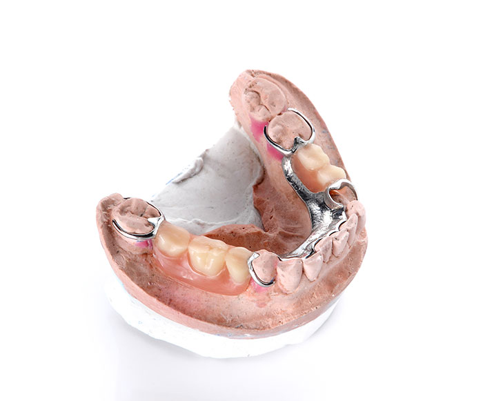 image for dentures vs. dental bridges