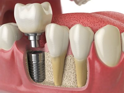 featured image for Can I afford dental implants