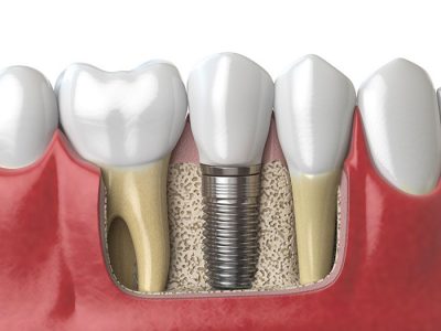 featured image for dentures vs. dental implants