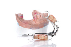 image for Are partial dentures in Manila worth it