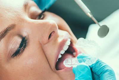 featured image for Can the dentist whiten my teeth