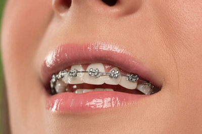 featured image for How much are braces