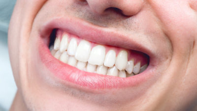 featured image for How do you keep your teeth white