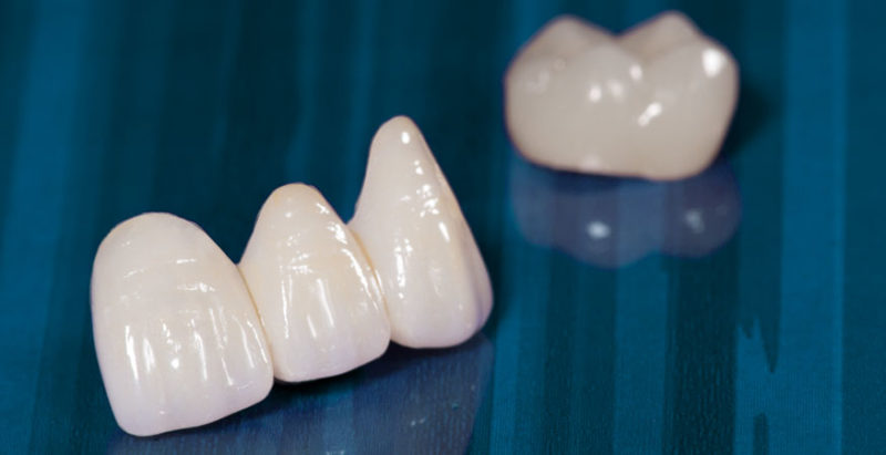 featured image for benefits of dental crowns