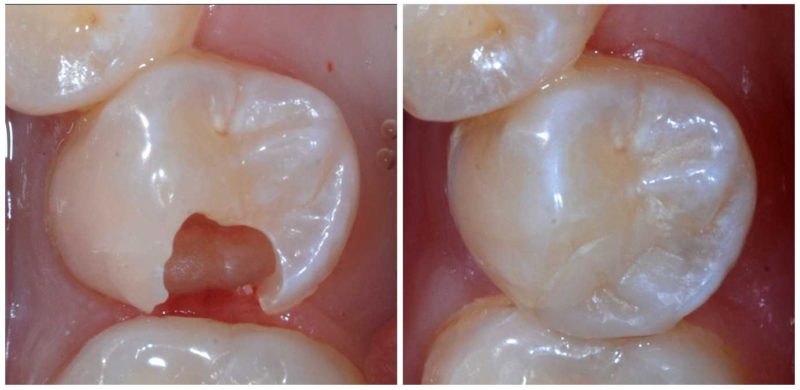 image for How do you fix damaged teeth