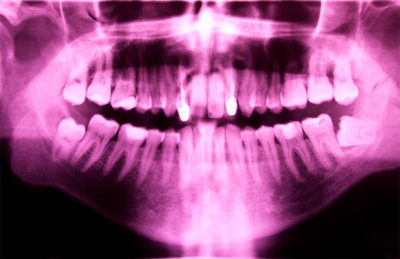 featured image for price of a root canal