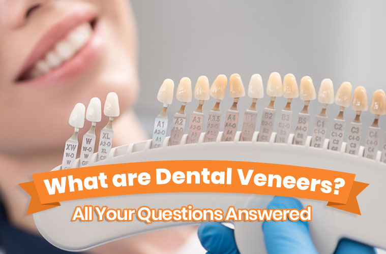 What are Dental Veneers? All Your Questions Answered