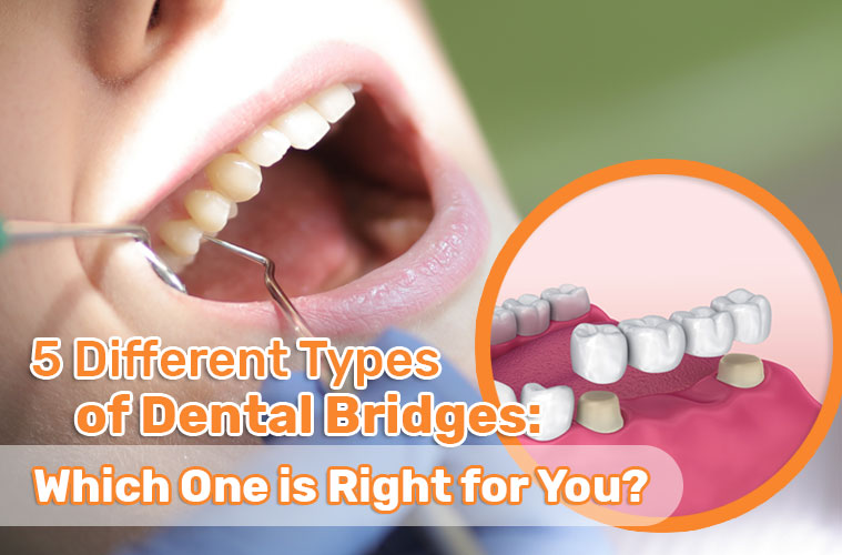 5 Different Types of Dental Bridges: Which One is Right for You?